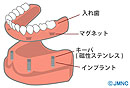 インプラントオーバーデンチャー