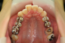 銀歯の付け替え(治療前)