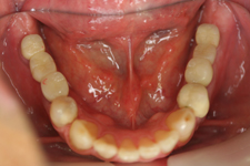 インプラントの治療例3-2