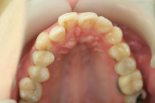 銀歯の付け替え(治療後)