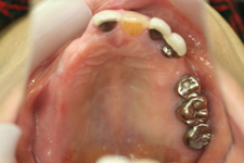 金属床の部分義歯(治療前)
