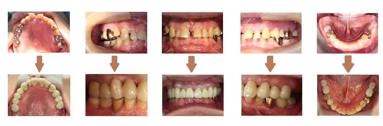 重度歯周炎の治療例