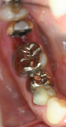 銀歯が気になる方向けの審美治療1
