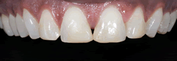 歯の隙間（歯の大きさ）の改善9