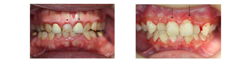 歯ぐきの腫れ・出血