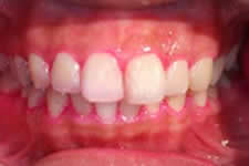 これがPMTCの概要です。虫歯の予防のため歯にフッ化合物を塗って終了します。