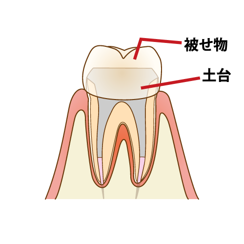 根管治療（歯内療法）とは