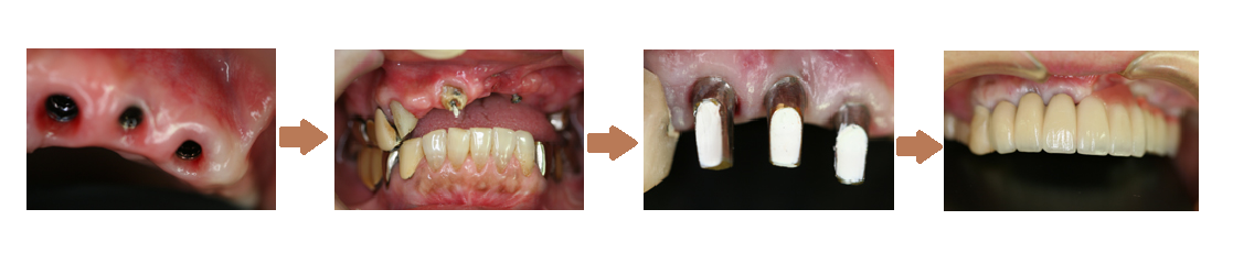 インプラントの治療例2-6