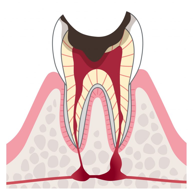 C4【歯根に達した虫歯】
