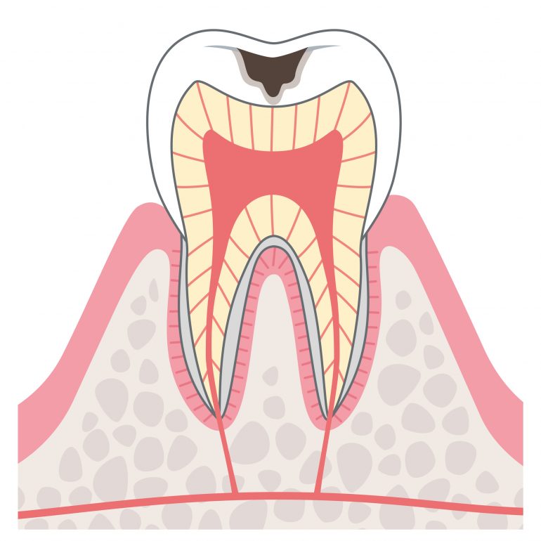 C2【象牙質の虫歯】