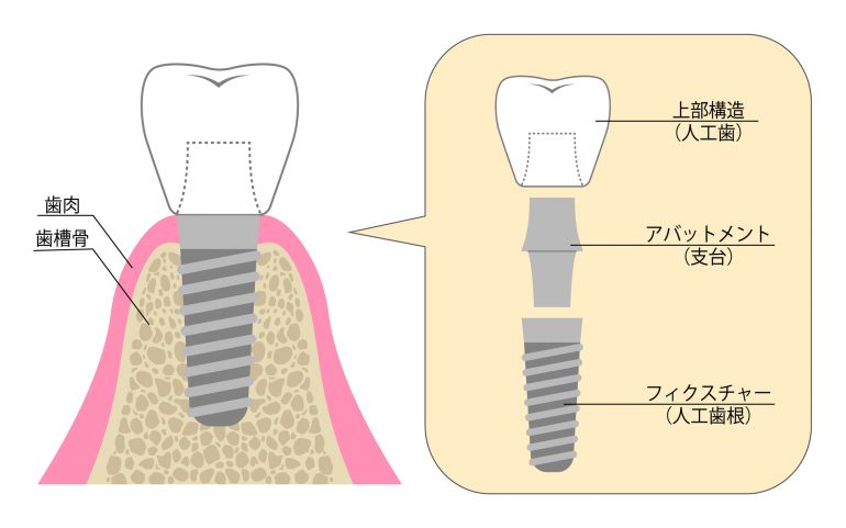 インプラント治療