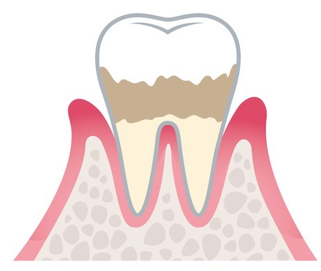 軽度歯周病