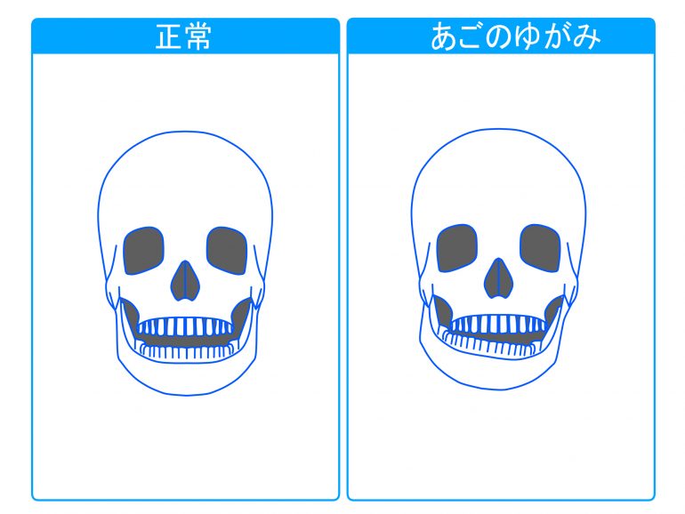 顎関節症